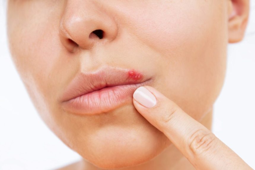 herpes remedii naturale pentru ameliorarea simptomelor si accelerarea vindecarii 679c867f12f1b