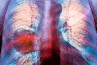 diagnosticele de cancer pulmonar sunt in crestere in randul persoanelor care nu fumeaza niciodata 67a1c60541ef8