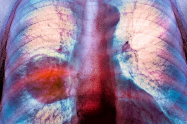 diagnosticele de cancer pulmonar sunt in crestere in randul persoanelor care nu fumeaza niciodata 67a1c60541ef8