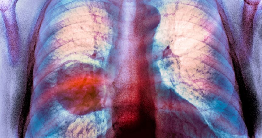 diagnosticele de cancer pulmonar sunt in crestere in randul persoanelor care nu fumeaza niciodata 67a1c60541ef8