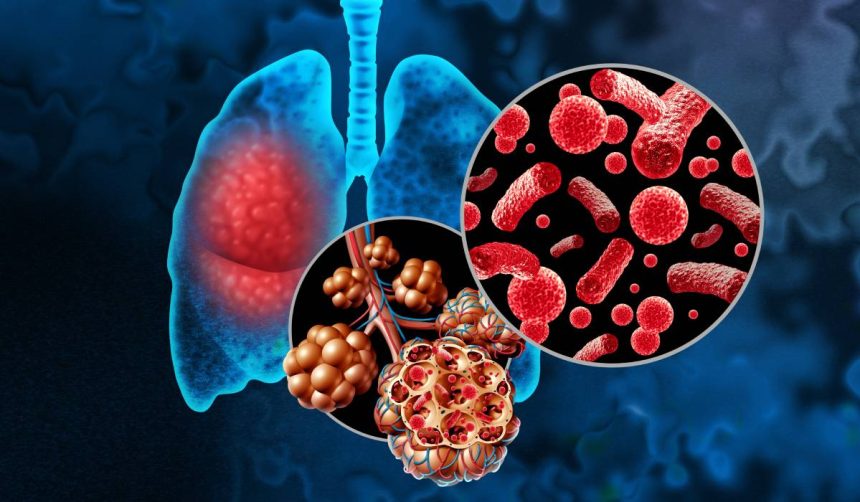 gripa implicata in 25 din cazurile de exacerbare a bolilor pulmonare cronice modificarile produse la nivelul cailor aeriene sunt mult mai dificil de gestionat si tratat 67a30ffbbdf91