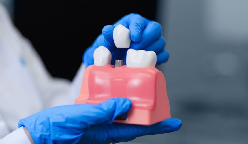 implantologia dentara de la a la z varsta inaintata nu este un obstacol pentru implanturile dentare 67b9b1974725f