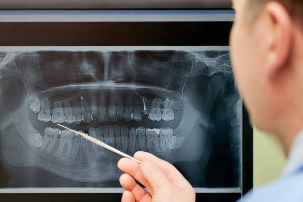 peste 50 dintre romanii cu varste de peste 40 de ani au lucrari dentare cu plombe cu mercur tehnica periculoasa interzisa deja in ue de la inceputul anului 2025 67ae368679ad9
