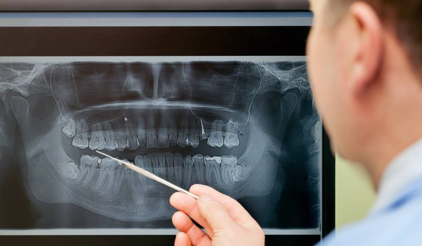 peste 50 dintre romanii cu varste de peste 40 de ani au lucrari dentare cu plombe cu mercur tehnica periculoasa interzisa deja in ue de la inceputul anului 2025 67ae368679ad9