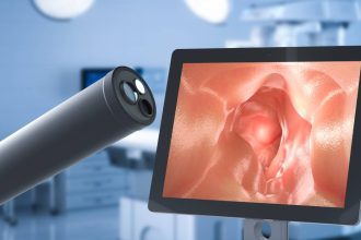 polipii colonici sunt din ce in ce mai frecventi medicii atrag atentia la simptome precum crampe dureri abdominale sangerari 67af108112819