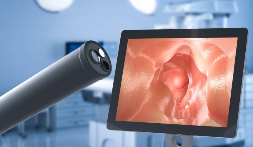 polipii colonici sunt din ce in ce mai frecventi medicii atrag atentia la simptome precum crampe dureri abdominale sangerari 67af108112819