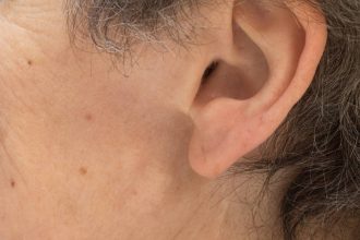 ce boli dermatologice pot creste riscul de cancer de piele este foarte important sa fii examinat de medic 67ca8ec4584a4