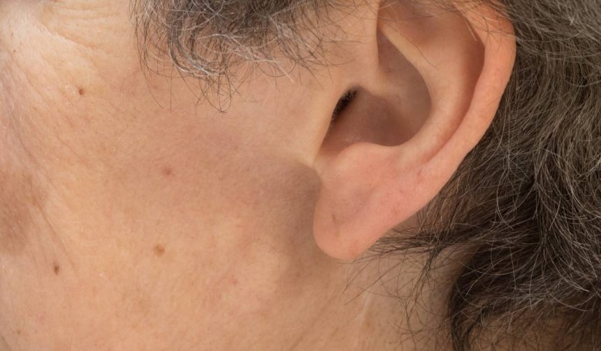 ce boli dermatologice pot creste riscul de cancer de piele este foarte important sa fii examinat de medic 67ca8ec4584a4