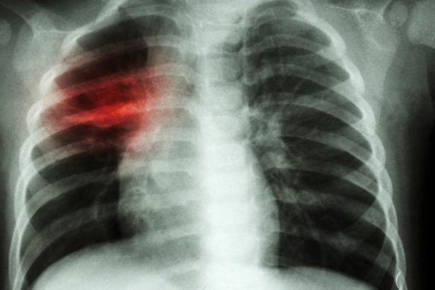 crestere alarmanta a cazurilor de tuberculoza la copii in europa si asia centrala oms cere masuri imediate 67e129de18a87