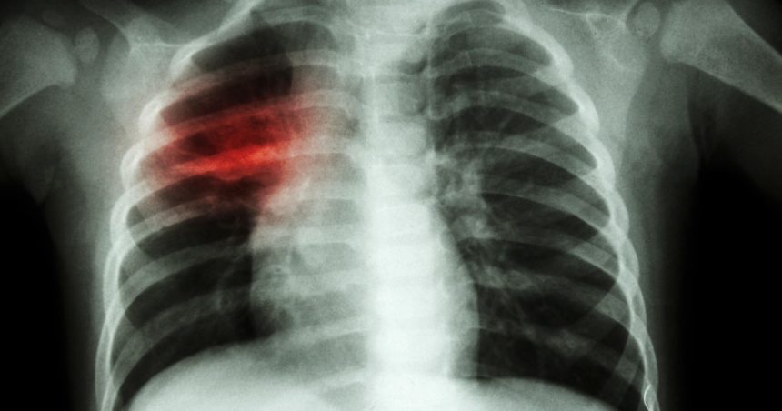 crestere alarmanta a cazurilor de tuberculoza la copii in europa si asia centrala oms cere masuri imediate 67e129de18a87