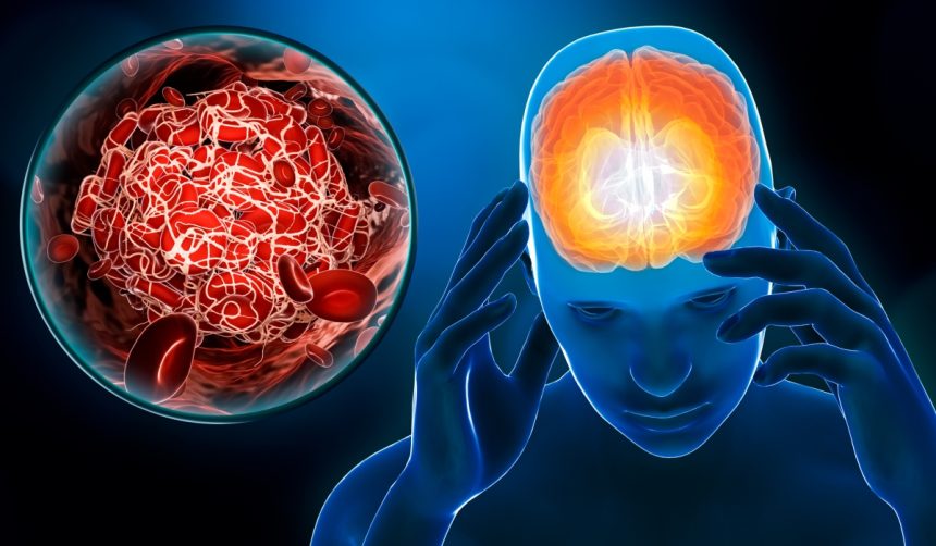 doua suplimente pe care sa nu le combini niciodata creste riscul de accident vascular cerebral 67d96ad3e56ae