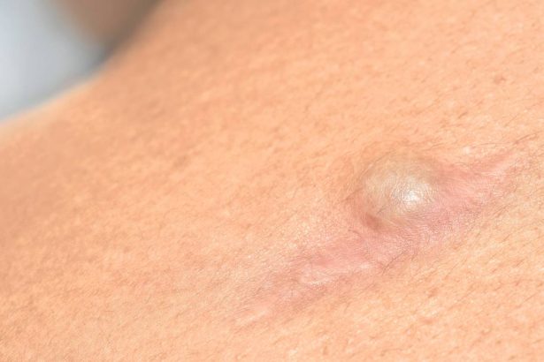 greseala pe care o faci si care duce la reaparitia chistului sebaceu 67d971cb53450