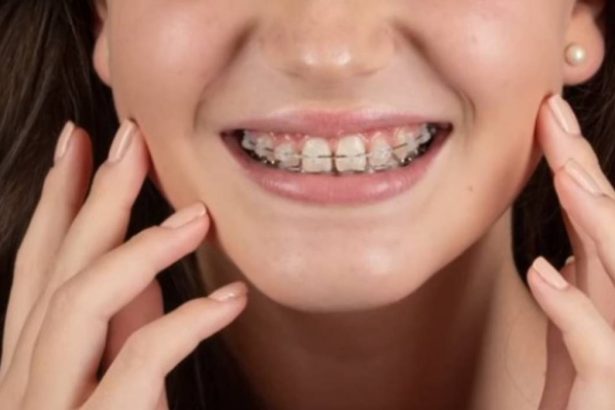 p aparatul dentar si estetica faciala cum iti poate imbunatati trasaturile fetei 67cef3c4a68a3
