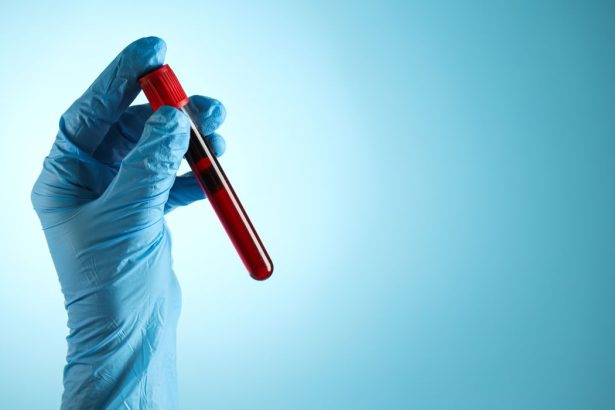 persoanele cu aceasta grupa sangvina mai predispuse sa faca infarct inainte de varsta de 60 de ani 67d04c52547c5
