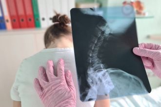 scolioza la copii cauze diagnostic tratament 67d00d2c30e22