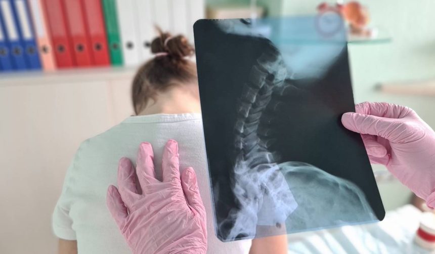 scolioza la copii cauze diagnostic tratament 67d00d2c30e22