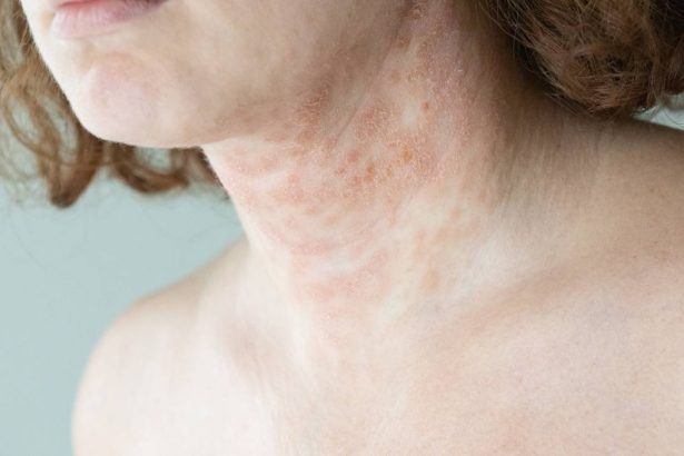 solutii blande pentru dermatita atopica 67dad873ac60d