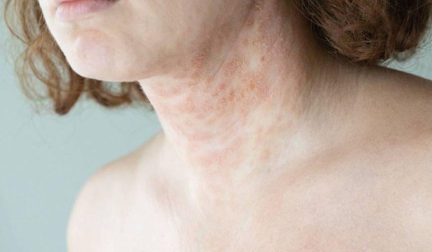 solutii blande pentru dermatita atopica 67dad873ac60d