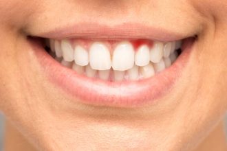 ce carente ai daca iti sangereaza gingiile sau iti apar afte 68275518aec1f