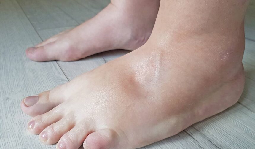 cum sa scapi de retentia de apa dupa ce ai mancat prea sarat amestecul natural care actioneaza imediat 685e7be4ed2f5