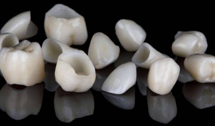 p coroanele dentare explicate ce trebuie sa stii despre fiecare tip 684d3c38cb3c0
