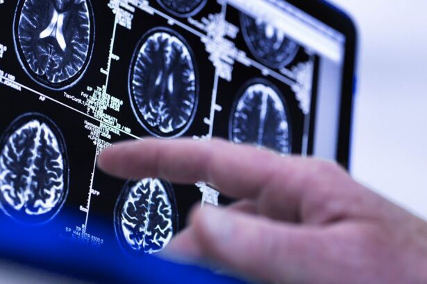 could a single brain scan predict the risk of age related conditions like dementia 68681e6803184