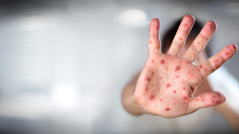 moartea unui copil bolnav de rujeola a starnit un val de conspiratii antivacciniste in marea britanie 687dd987e15eb