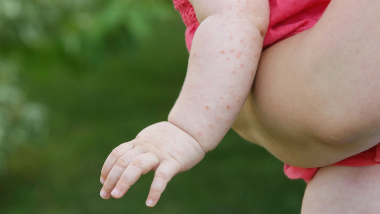 sua se confrunta cu cea mai grava epidemie de rujeola din secolul xxi secretarul de stat robert kennedy jr acuzat ca o alimenteaza 686c12fae65db