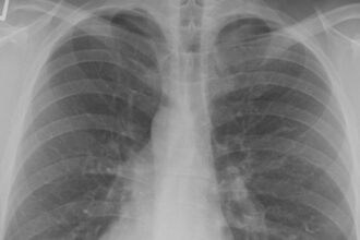 ce este si cum se transmite boala legionarilor epidemie cinci morti si peste 100 de cazuri confirmate 68a59bb740e6f