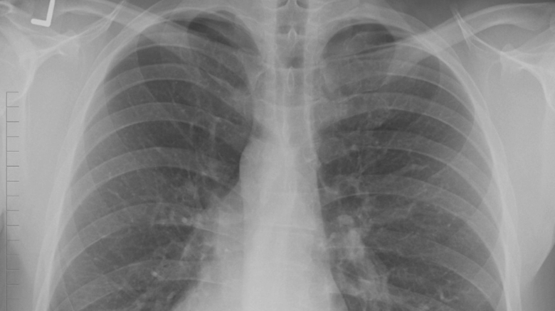 ce este si cum se transmite boala legionarilor epidemie cinci morti si peste 100 de cazuri confirmate 68a59bb740e6f